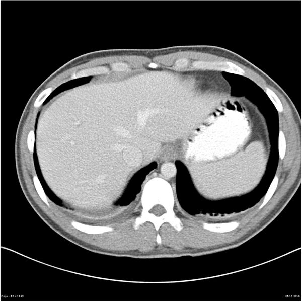 File:Acute appendicitis (Radiopaedia 25364-25615 B 3).jpg