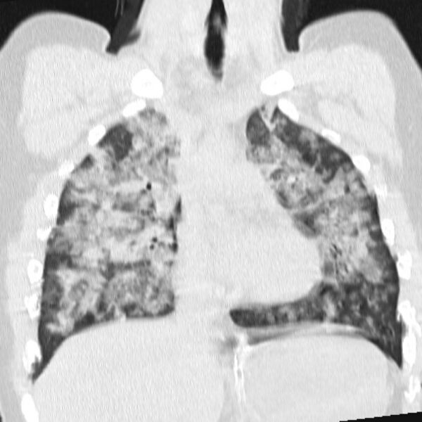 File:Acute aspiration pneumonitis (Radiopaedia 33605-34703 Coronal lung window 39).jpg