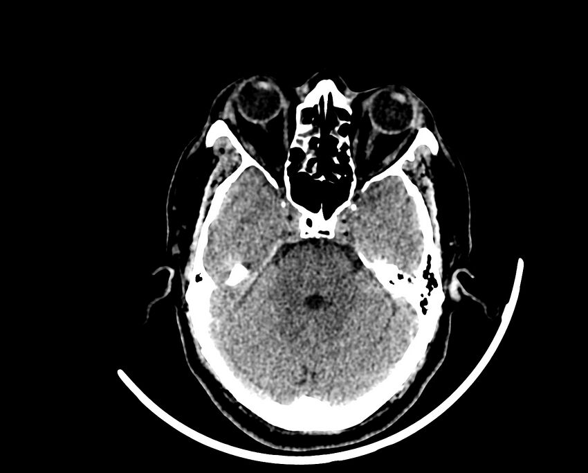 Acute cerebral infarct (Radiopaedia 35604-37123 Axial non-contrast 28).jpg
