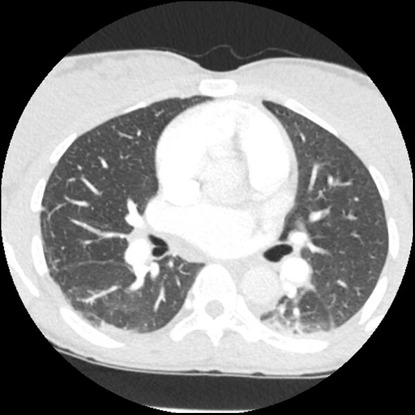File:Acute chest syndrome - sickle cell disease (Radiopaedia 42375-45499 Axial lung window 94).jpg