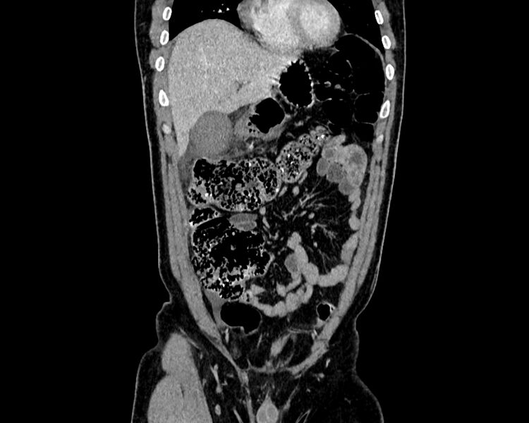 File:Acute cholecystitis (Radiopaedia 53216-59182 Coronal C+ portal venous phase 5).jpg