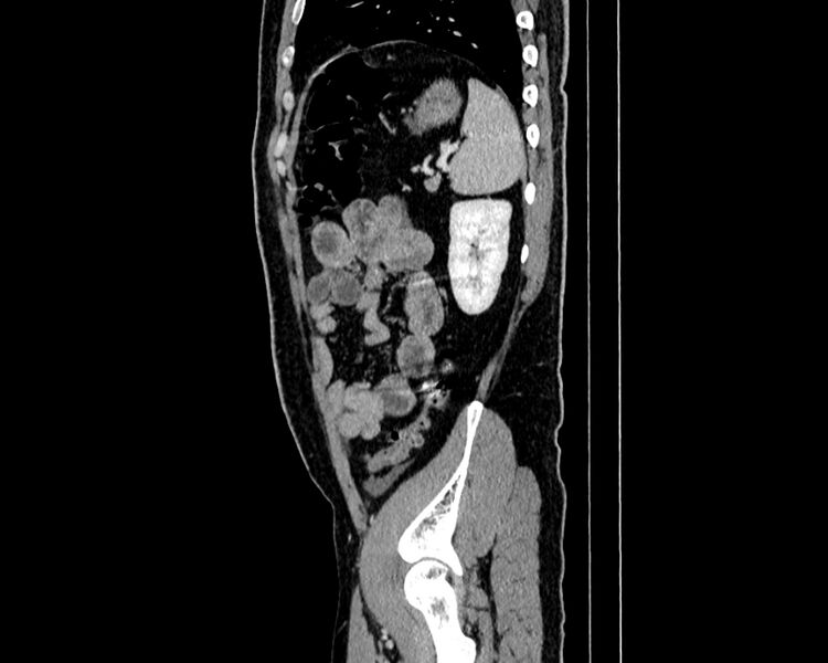 File:Acute cholecystitis (Radiopaedia 53216-59182 Sagittal C+ portal venous phase 19).jpg