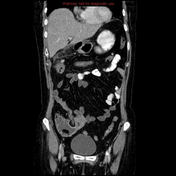 File:Acute gangrenous cholecystitis (Radiopaedia 10123-10661 Coronal C+ portal venous phase 1).jpg