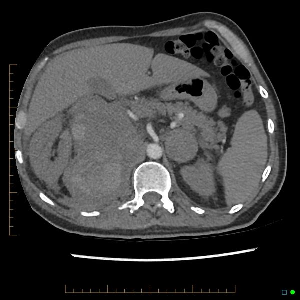 File:Acute hemorrhage into adrenal metastasis from NSCLC (Radiopaedia 43135-46429 Axial C+ CTPA 15).jpg