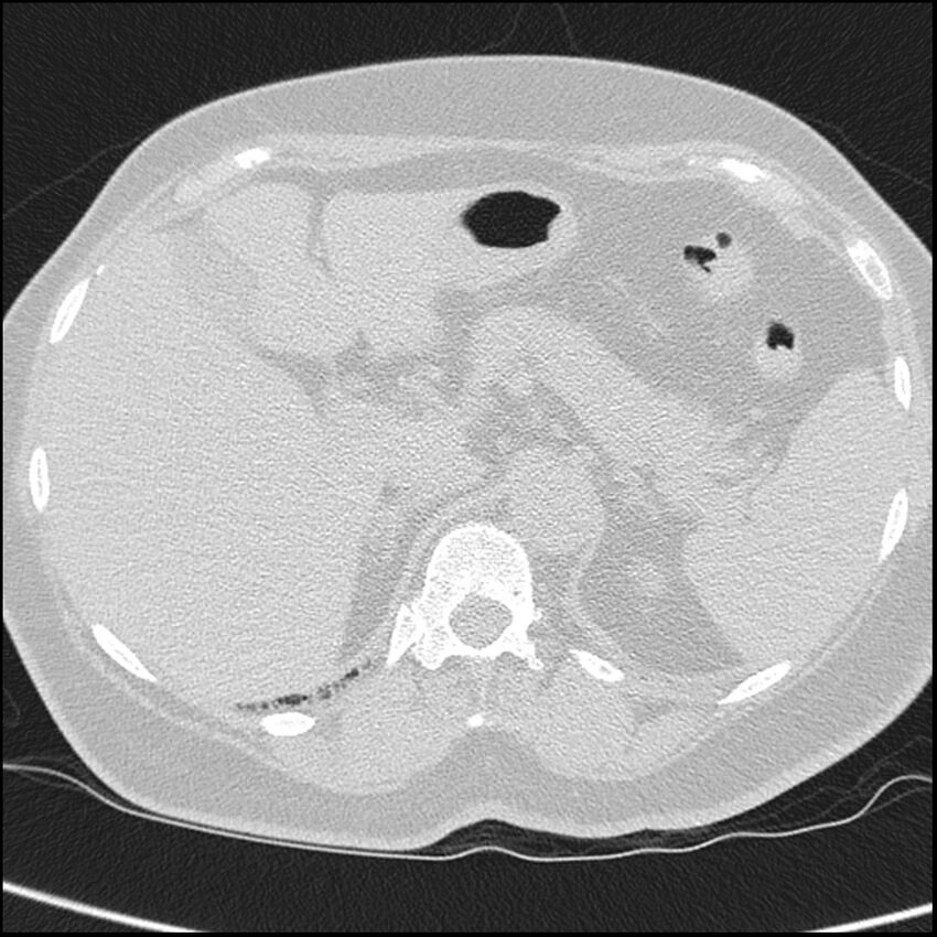 Acute interstitial pneumonitis (Radiopaedia 45404-49453 Axial lung window 79).jpg