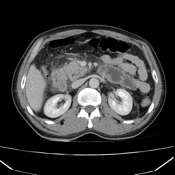 File:Acute pancreatitis (Radiopaedia 22572-22596 Axial C+ portal venous phase 27).jpg