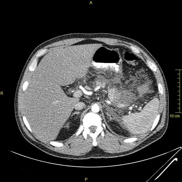 File:Acute pancreatitis (Radiopaedia 23231-23290 Axial C+ arterial phase 17).JPG