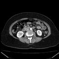 Acute pancreatitis - Balthazar C (Radiopaedia 26569-26714 Axial C+ arterial phase 45).jpg