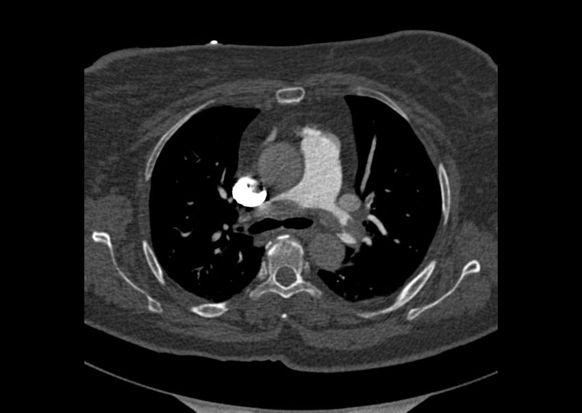 Acute pulmonary embolism (Radiopaedia 29938-30466 Axial C+ CTPA 42).jpg