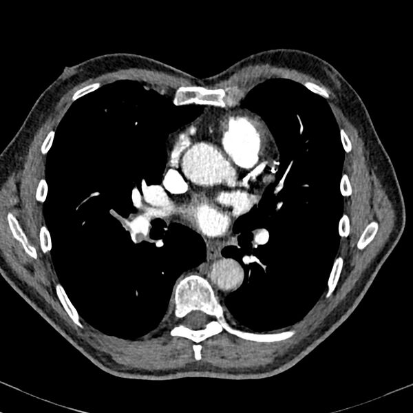 File:Acute pulmonary embolism (Radiopaedia 81677-95570 Axial C+ CTPA 55).jpg