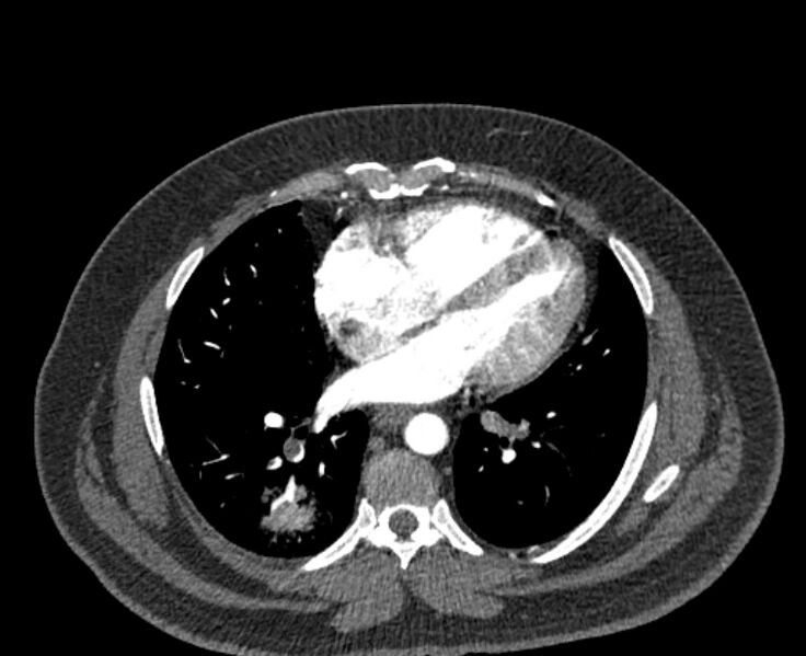 File:Acute pulmonary embolism with pulmonary infarcts (Radiopaedia 77688-89908 Axial C+ CTPA 41).jpg