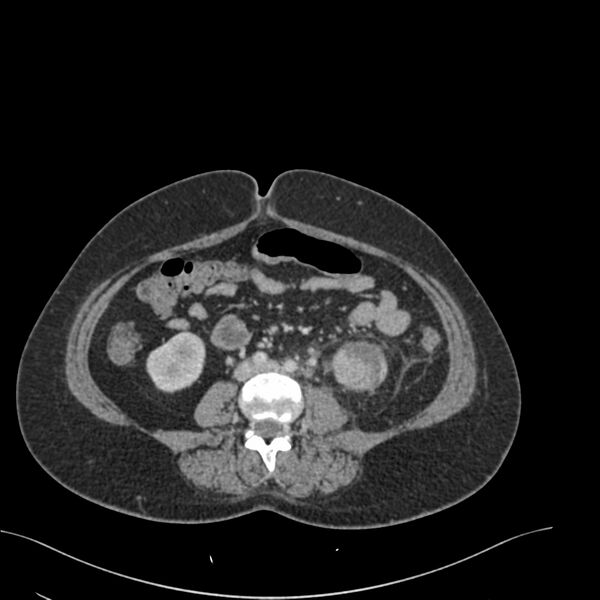 File:Acute pyelonephritis with renal vein thrombosis (Radiopaedia 58020-65053 Axial renal parenchymal phase 123).jpg