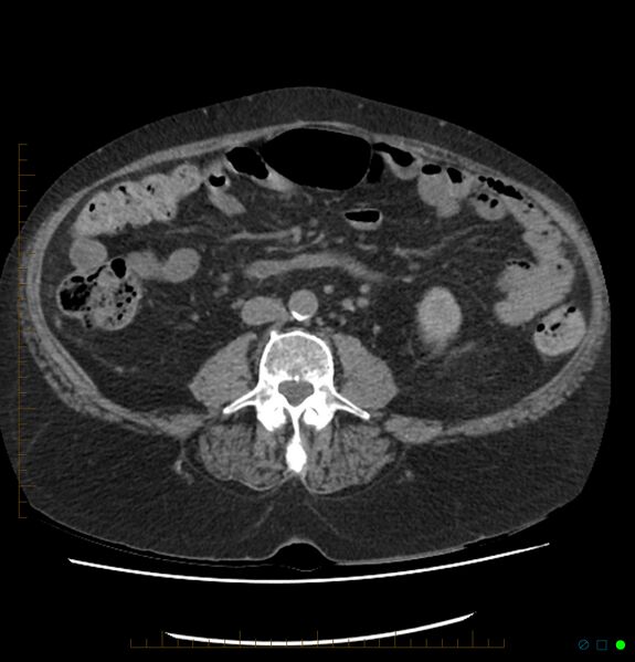 File:Acute renal failure post IV contrast injection- CT findings (Radiopaedia 47815-52557 Axial non-contrast 45).jpg