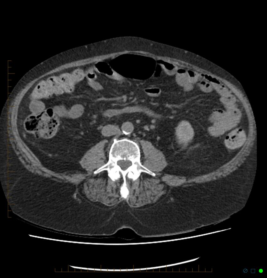 Acute renal failure post IV contrast injection- CT findings (Radiopaedia 47815-52557 Axial non-contrast 45).jpg