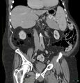 Acute renal failure post IV contrast injection- CT findings (Radiopaedia 47815-52559 Coronal C+ portal venous phase 13).jpg