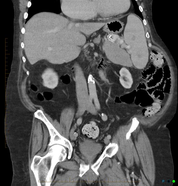 File:Acute renal failure post IV contrast injection- CT findings (Radiopaedia 47815-52559 Coronal C+ portal venous phase 13).jpg