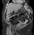 Acute renal failure post IV contrast injection- CT findings (Radiopaedia 47815-52559 Coronal C+ portal venous phase 3).jpg
