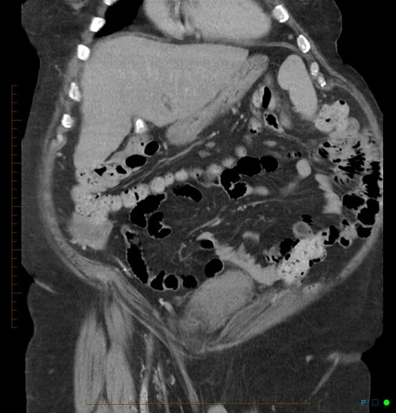 File:Acute renal failure post IV contrast injection- CT findings (Radiopaedia 47815-52559 Coronal C+ portal venous phase 3).jpg