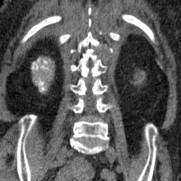 File:Acute tubular necrosis (Radiopaedia 28077-28334 Coronal non-contrast 29).jpg