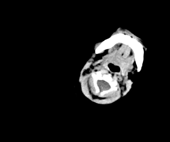 File:Acute ventriculitis (Radiopaedia 57502-64459 Axial non-contrast 1).jpg