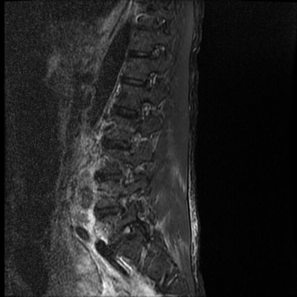 File:Acute vertebral body compression fractures (Radiopaedia 31757-32694 Sagittal STIR 4).jpg