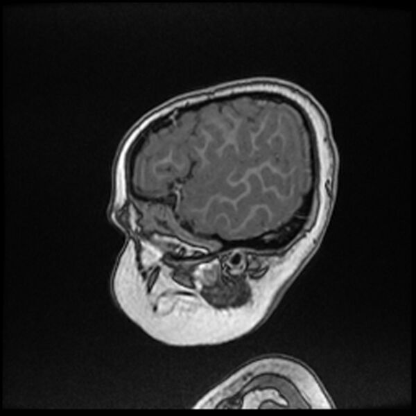 File:Adamantinomatous craniopharyngioma (Radiopaedia 77407-89529 Sagittal T1 C+ 17).jpg