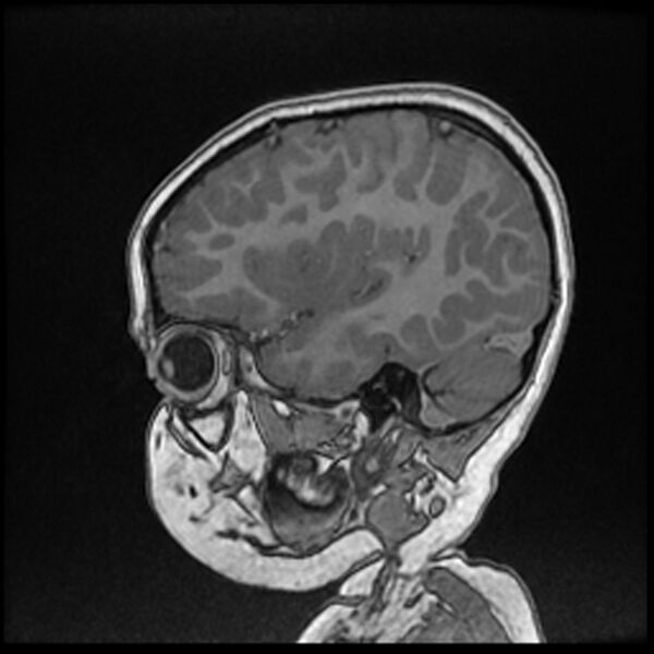 File:Adamantinomatous craniopharyngioma (Radiopaedia 77407-89529 Sagittal T1 C+ 34).jpg