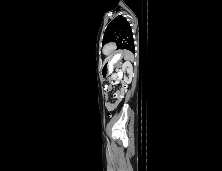 File:Addison disease (Radiopaedia 49318-54412 Sagittal C+ portal venous phase 18).jpg