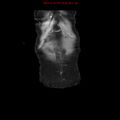Adenocarcinoma of the colon (Radiopaedia 8191-9039 Coronal liver window 4).jpg