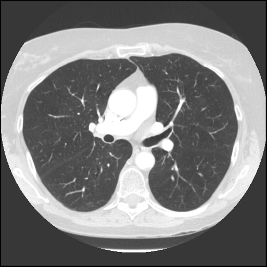 Adenocarcinoma of the lung (Radiopaedia 41015-43755 Axial lung window 55).jpg
