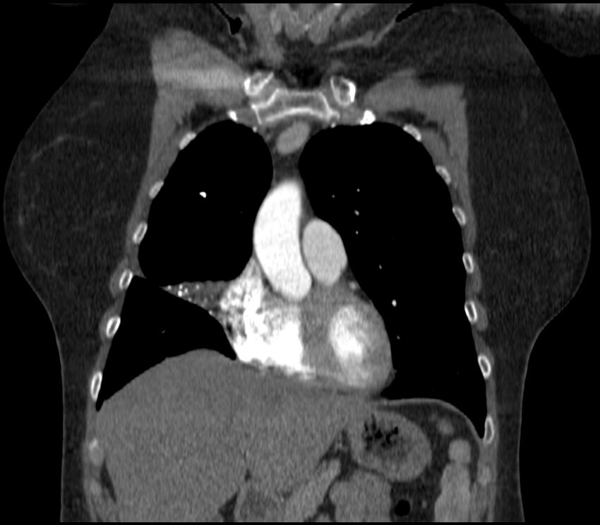 Adenocarcinoma of the lung (Radiopaedia 44205-47803 Coronal C+ portal venous phase 26).jpg