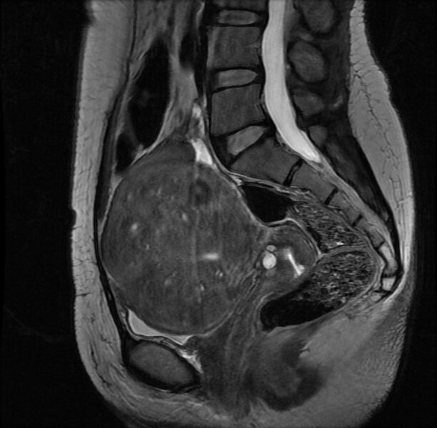 File:Adenomyosis on MRI (Radiopaedia 29328-29780 Sagittal T2 8).jpg
