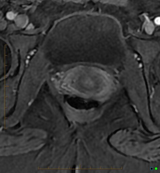 File:Adenomyosis uterus with hematometra (Radiopaedia 45779-50011 Axial T1 C+ fat sat 61).jpg