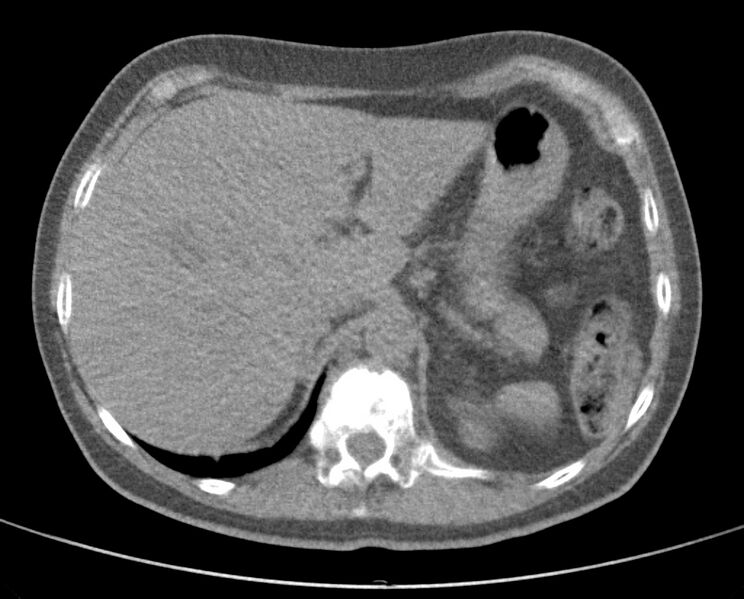 File:Adenosquamous lung carcinoma (Radiopaedia 22035-22030 non-contrast 57).jpg