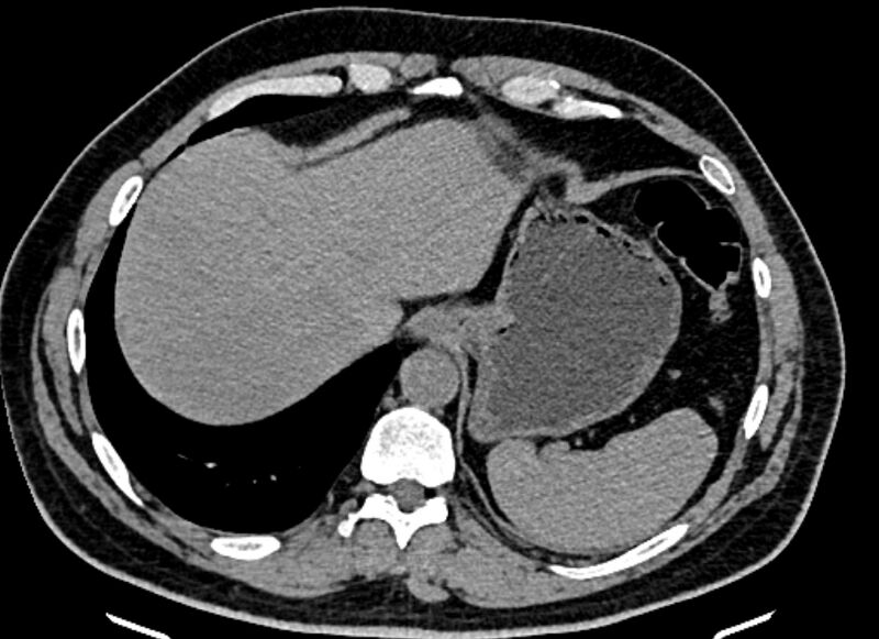 File:Adrenal metastases (Radiopaedia 73082-83791 Axial non-contrast 25).jpg