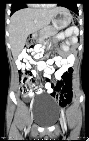File:Agenesis of the gallbladder (Radiopaedia 55454-61905 A 16).jpg