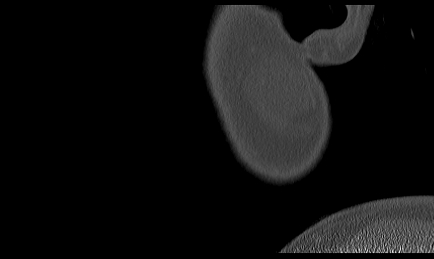 Ameloblastoma (Radiopaedia 33677-34806 Sagittal bone window 4).png