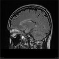 Amnestic syndrome secondary to hypoxic brain injury (Radiopaedia 24743-25004 D 15).jpg