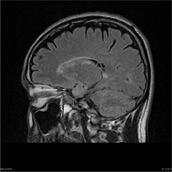 File:Amnestic syndrome secondary to hypoxic brain injury (Radiopaedia 24743-25004 D 15).jpg