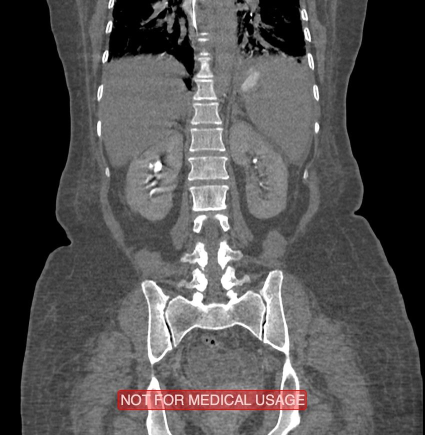 Amoebic enterocolitis with liver abscess (Radiopaedia 35100-36609 B 143).jpg