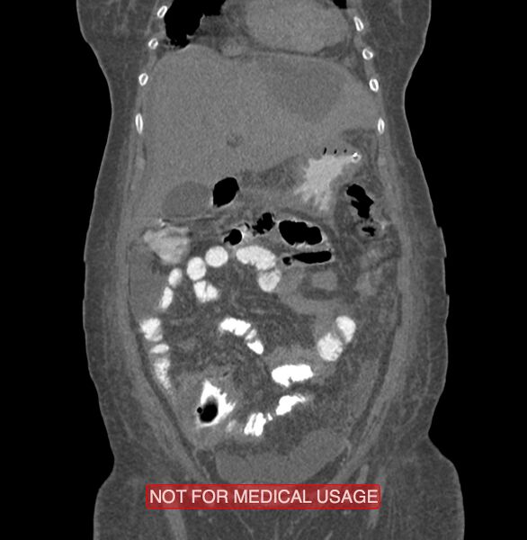 File:Amoebic enterocolitis with liver abscess (Radiopaedia 35100-36609 B 43).jpg