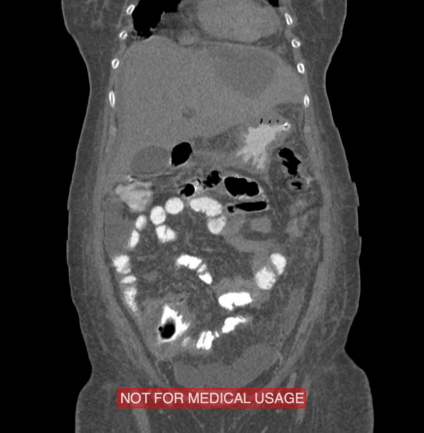 Amoebic enterocolitis with liver abscess (Radiopaedia 35100-36609 B 43).jpg