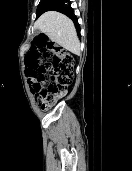 File:Ampullary adenocarcinoma (Radiopaedia 86093-102032 D 11).jpg