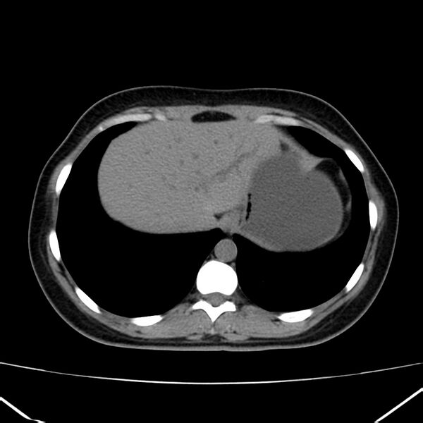 File:Ampullary tumor (Radiopaedia 22787-22816 Axial non-contrast 7).jpg
