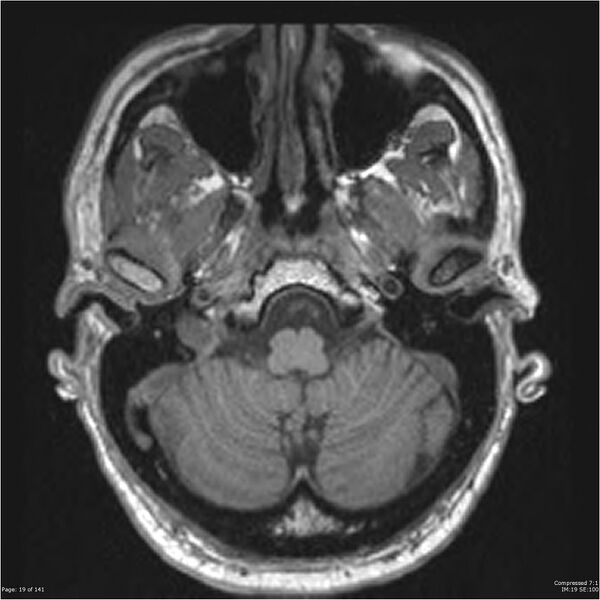 File:Anaplastic meningioma with recurrence (Radiopaedia 34452-35788 Axial T1 17).jpg