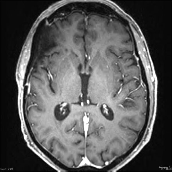File:Anaplastic meningioma with recurrence (Radiopaedia 34452-35788 Axial T1 C+ 74).jpg