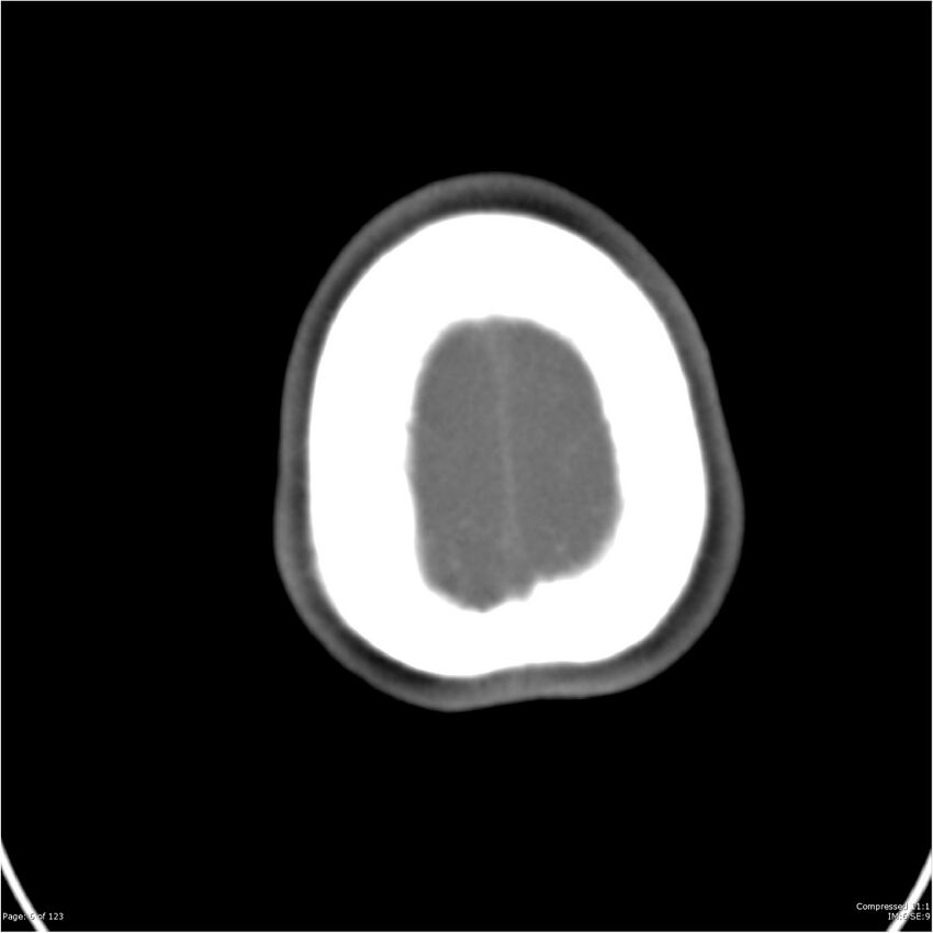Aneurysmal subarachnoid hemorrhage and Moya Moya disease (Radiopaedia 34306-35593 Axial CT COW 6).jpg