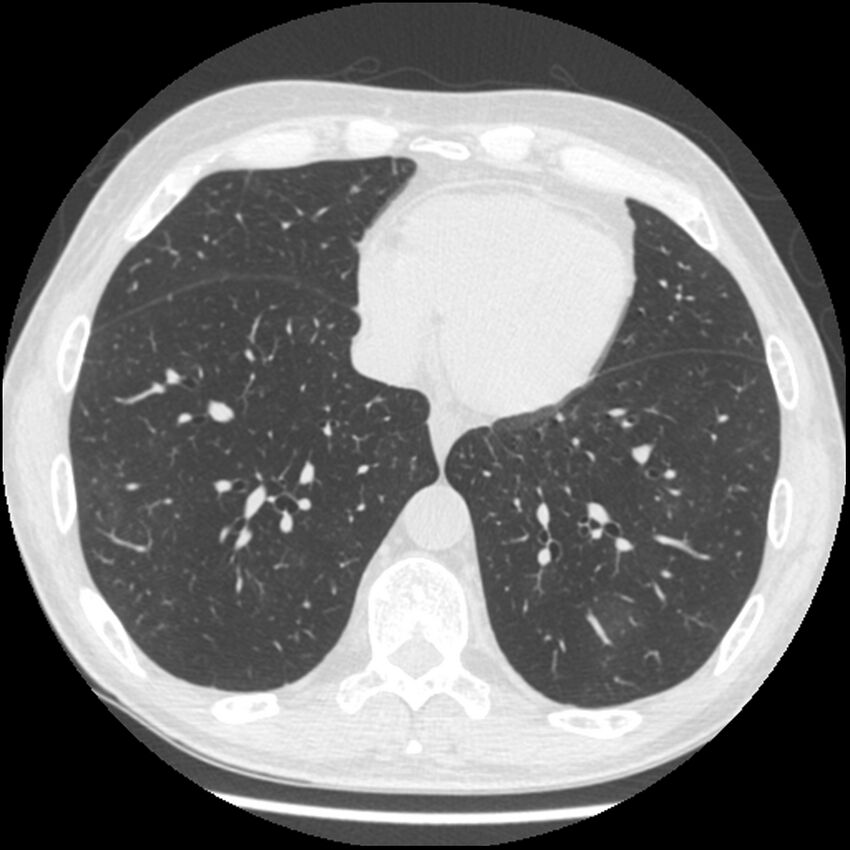 Angioinvasive aspergillosis (Radiopaedia 43957-47466 Axial lung window 48).jpg
