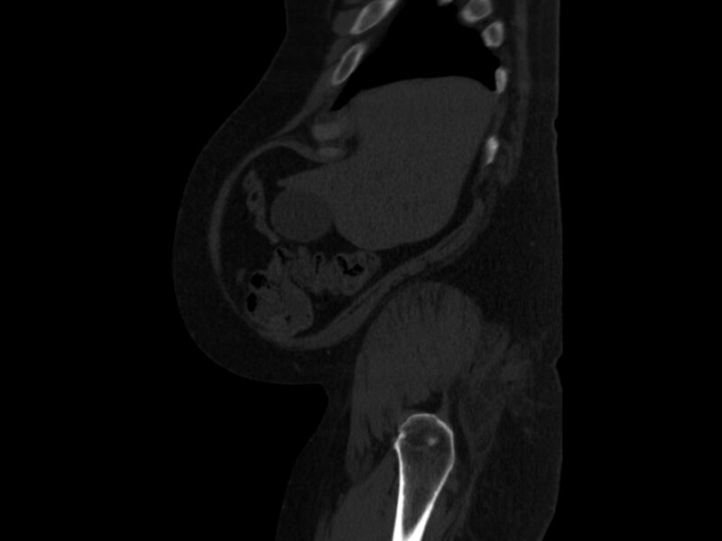 File:Ankylosing spondylitis (Radiopaedia 44609-48357 Sagittal bone window 4).jpg