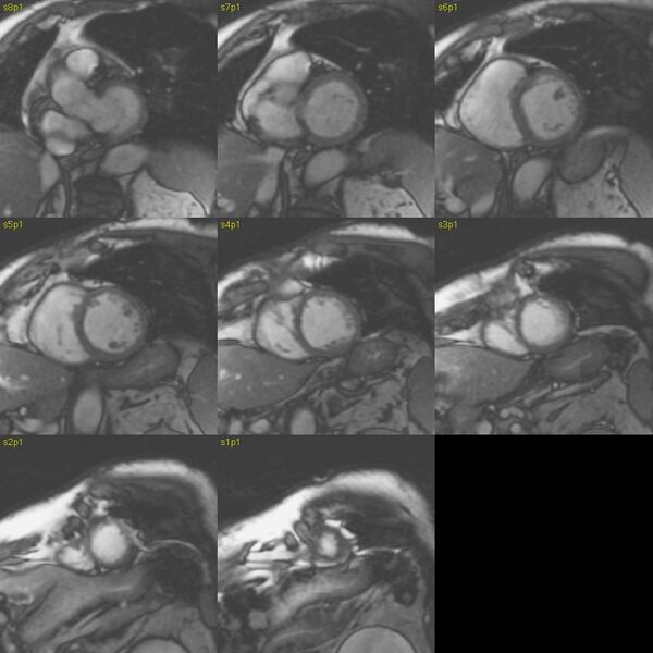 File:Anteroseptal hypokinesia after myocardial infarction (Radiopaedia 15978-15633 E 1).jpg
